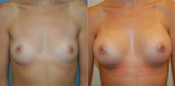Breast implants before and after.