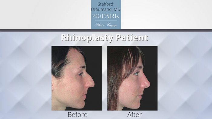 Rhinoplasty before and after - Broumand.