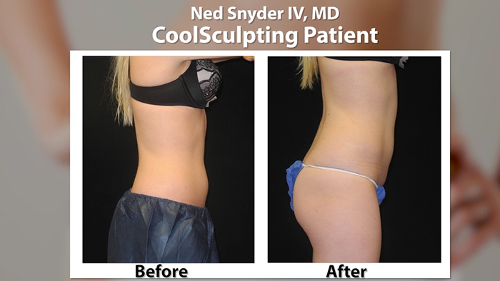 CoolSculpting before and after.