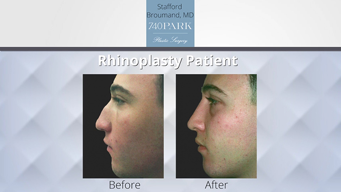 Rhinoplasty results.