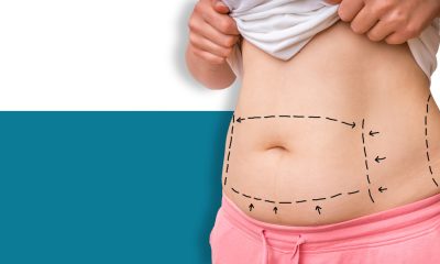 TissuGlu and a drainless tummy tuck.