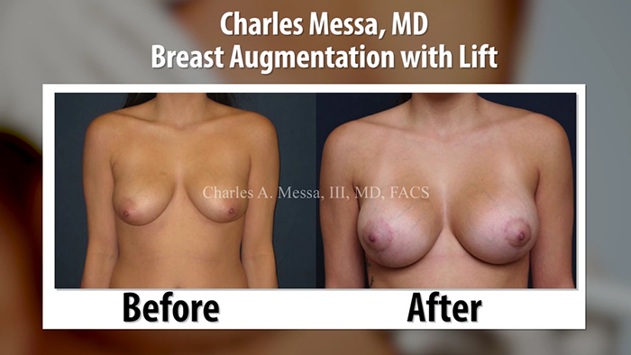 Augmentation mastopexy before and after - Dr. Messa.