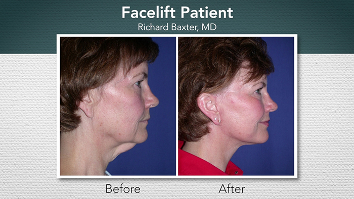 Facelift patient - Dr. Baxter.