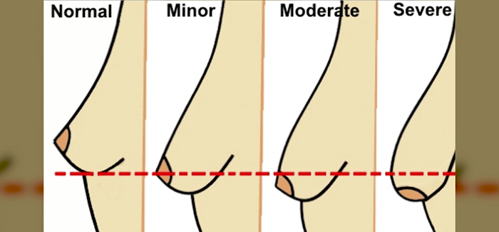 Nipple position in a mastopexy augmentation.