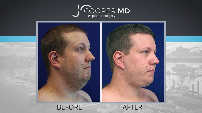 Younger male neck lift patient.