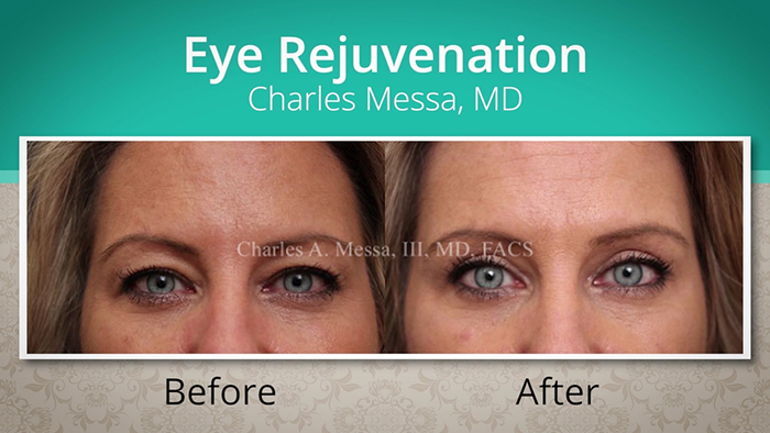 Blepharoplasty before and after.
