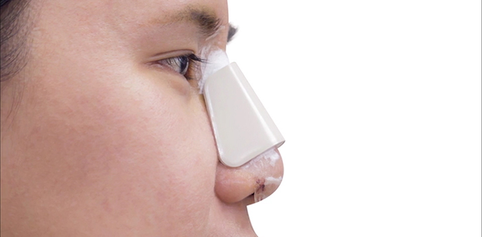 Rhinoplasty recovery splint.