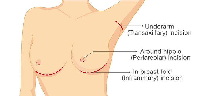 Breast augmentation incisions.