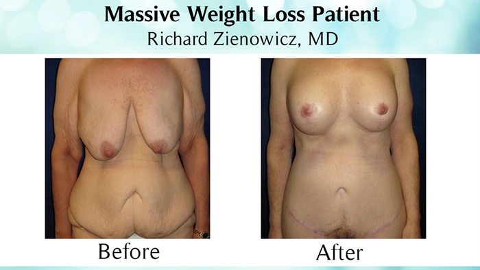 Massive weight loss patient - before and after.