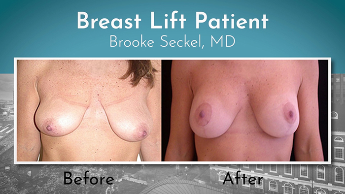 Breast lift patient.