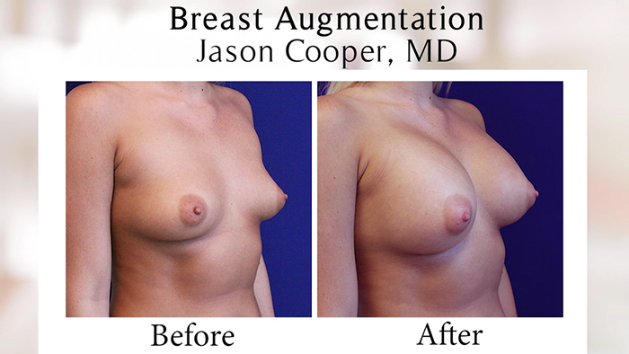 Breast augmentaton consultation - results.