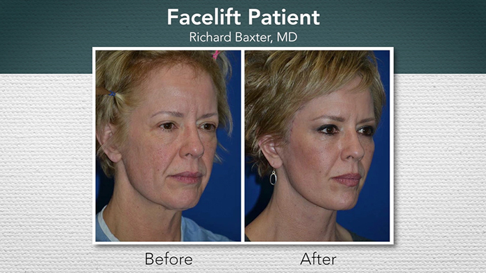 Facelift before and after - Dr. Baxter.