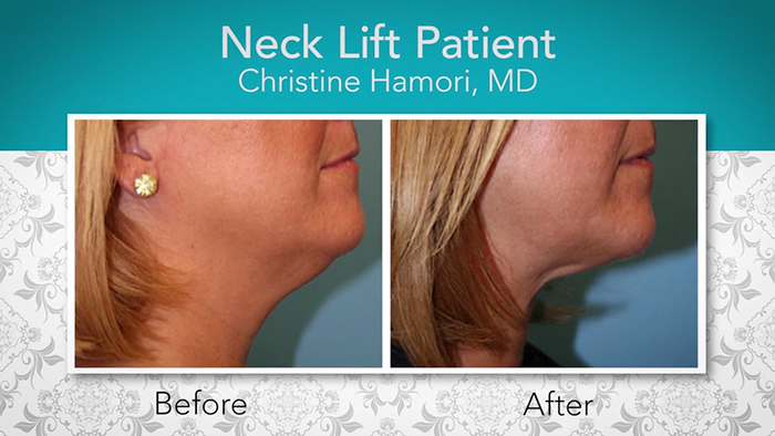 Neck lift patient 2 - Dr. Hamori.