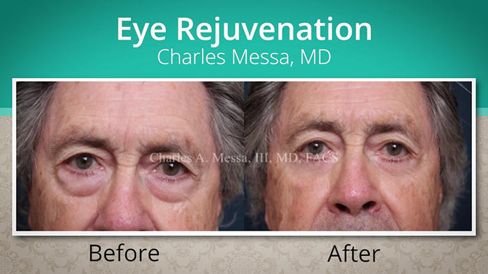 Male blepharoplasty patient - Dr. Messa.