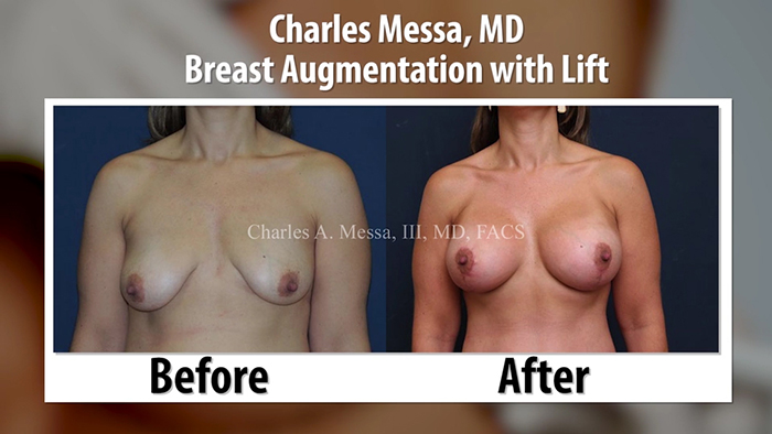 Augmentation mastopexy results - Dr. Charles Messa.