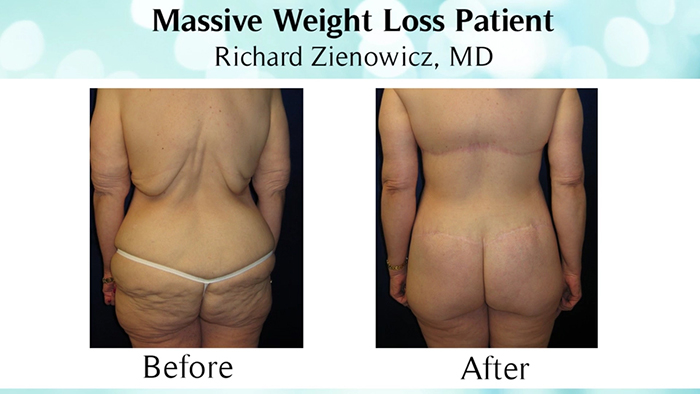 Massive weight loss patient - results.