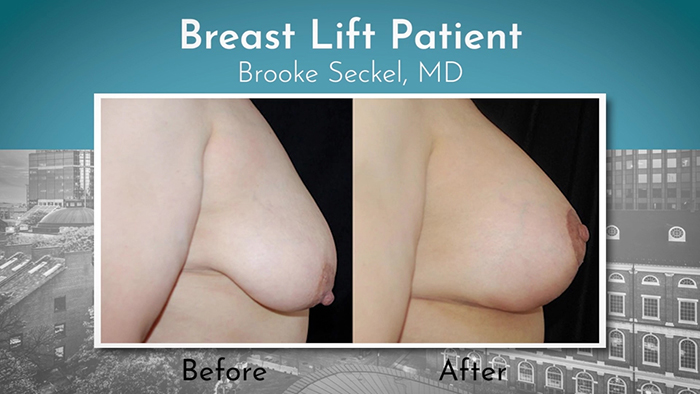 Breast lift patient 2.