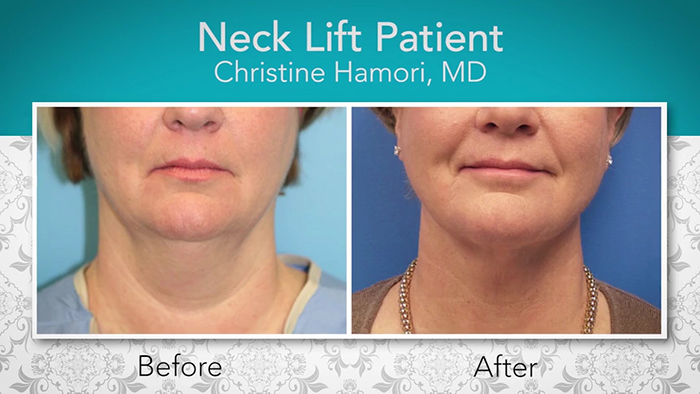 Neck lift patient - Dr. Hamori.