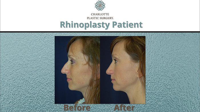 Rhinoplasty patient 1.