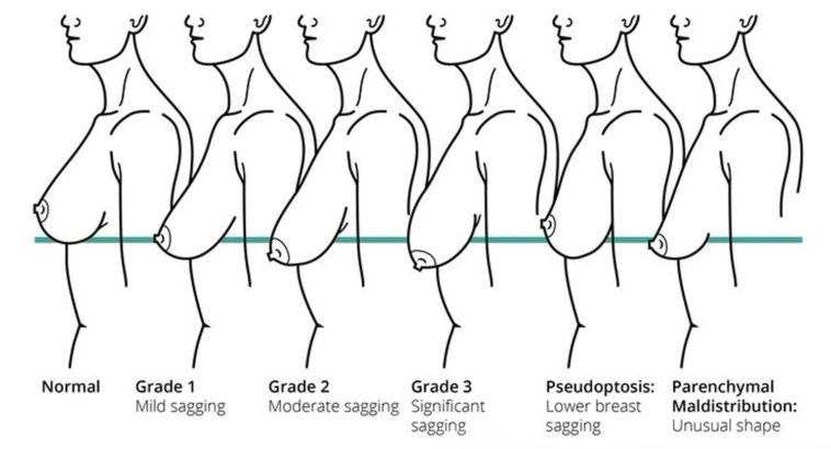 Breast lift chart.