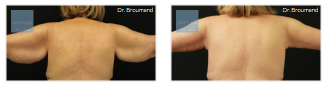 Arm lift before and after - Dr. Broumand.