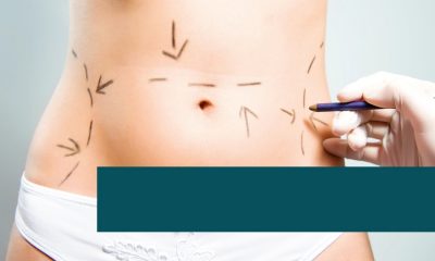 Liposuction of the abdomen.