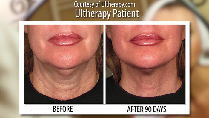 Ultherapy before and after - no scalpel.
