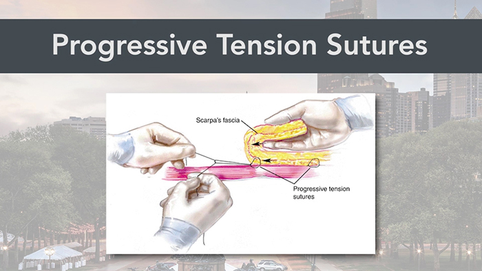 Improved tummy tuck - progressive tension sutures.