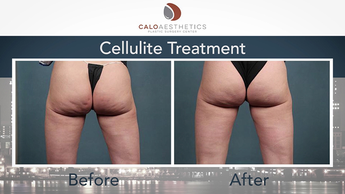 Cellulite Treatments that Work - The Plastic Surgery Channel