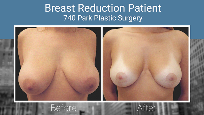 Breast reduction before and after.