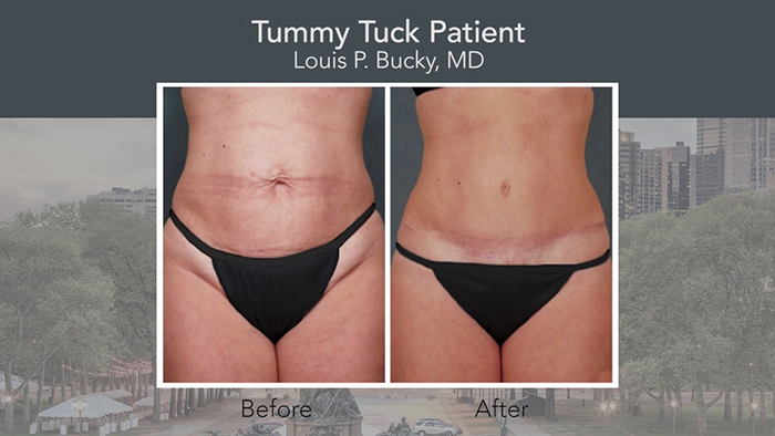 Improved tummy tuck results.