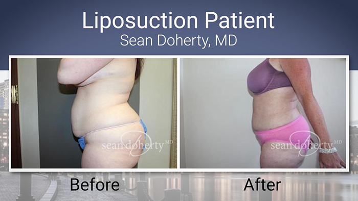 Liposuction patient - Dr. Doherty.