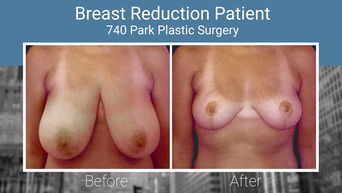 Breast reduction results - Dr. Broumand.