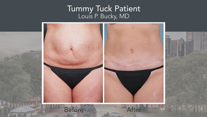 Improved tummy tuck before and after.