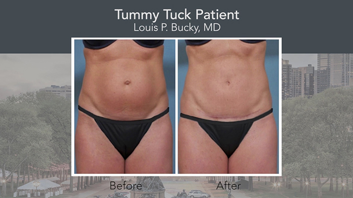 Tummy tuck patient - Dr. Bucky.