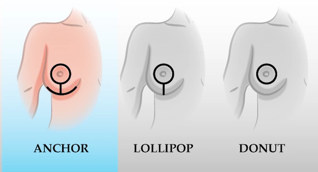 Breast reduction incisions.