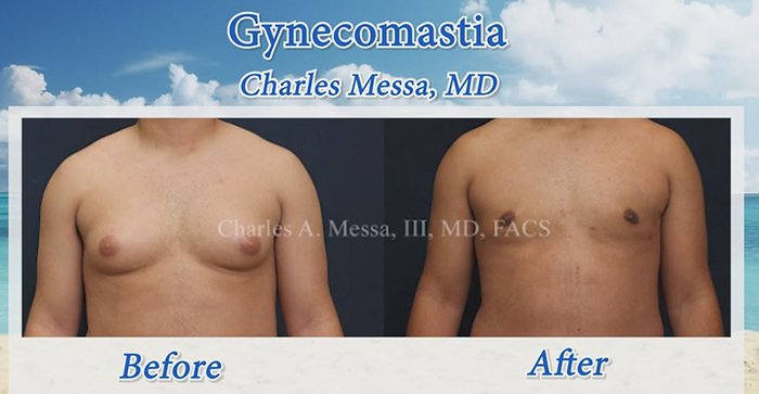 Gynecomastia before and after - Dr. Messa.