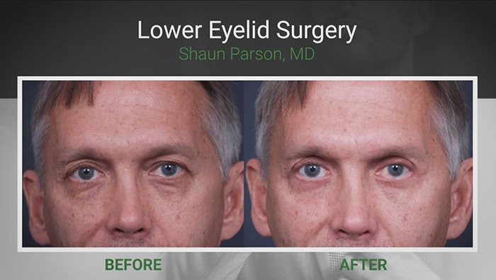 Male plastic surgery - blepharoplasty.