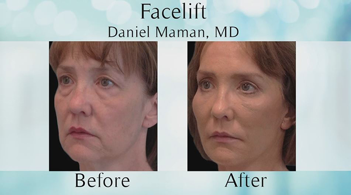 Facelift results - Dr. Maman.