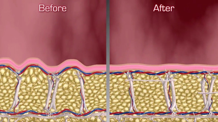 Cellfina results - non-surgical body contouring.