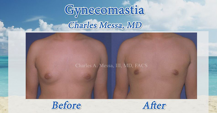 Gynecomastia patient - Dr. Messa.