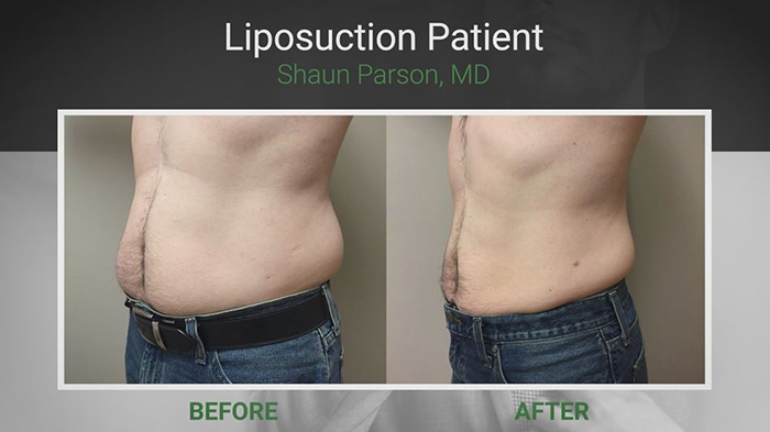 Male plastic surgery - liposuction.