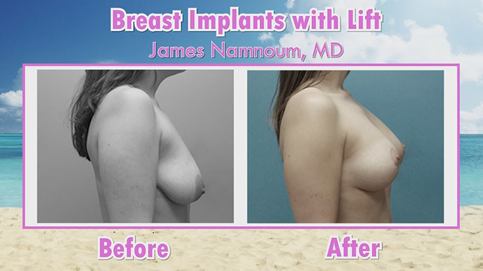 Breast augmentation results - Namnoum.