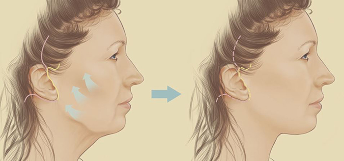 Facelift techniques.