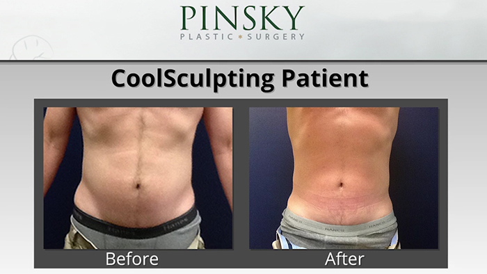 CoolSculpting male patient.