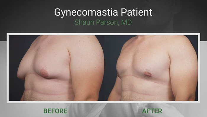 Male plastic surgery - gynecomastia.