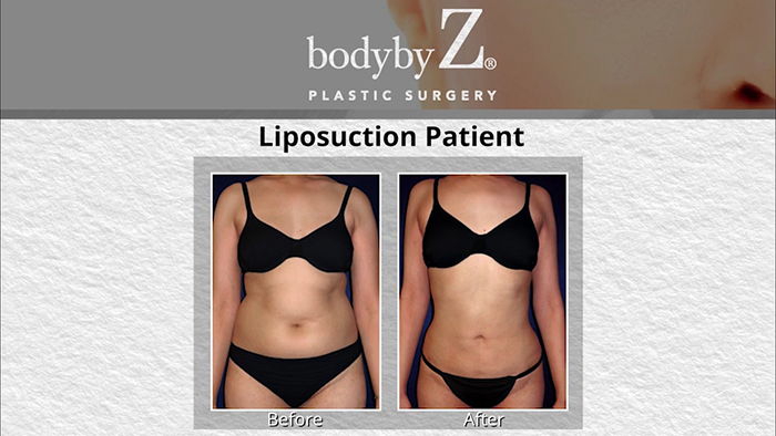Successful liposuction results.