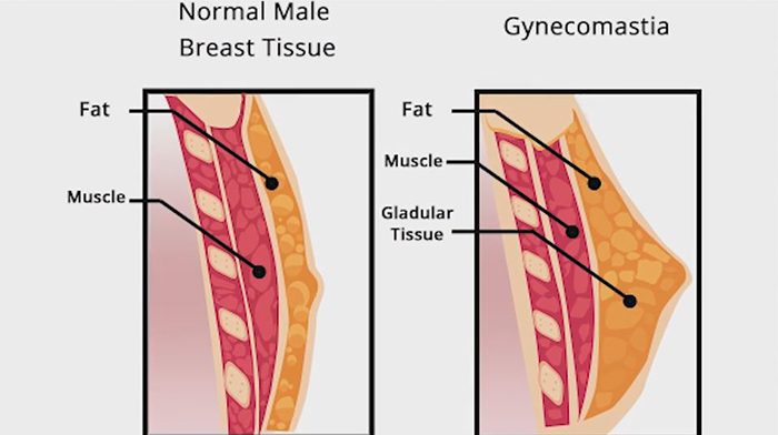 Gynecomastia causes.