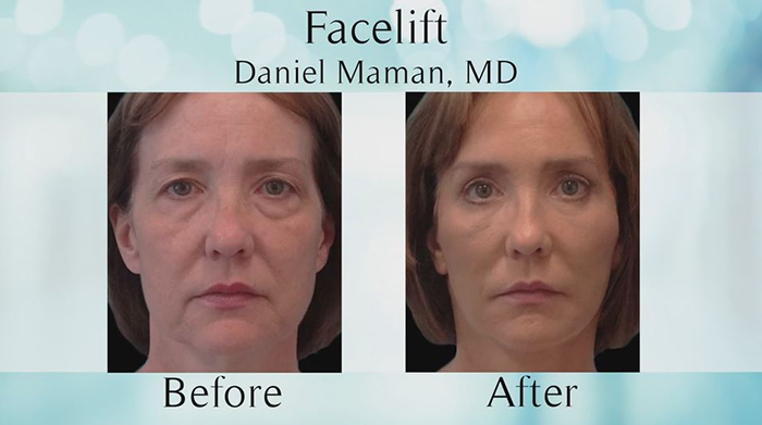 Facelift (rhytidectomy) results.
