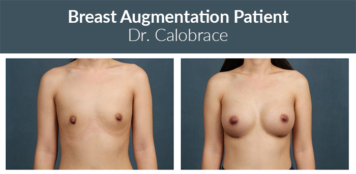 Fat grafting breast aug before and after.